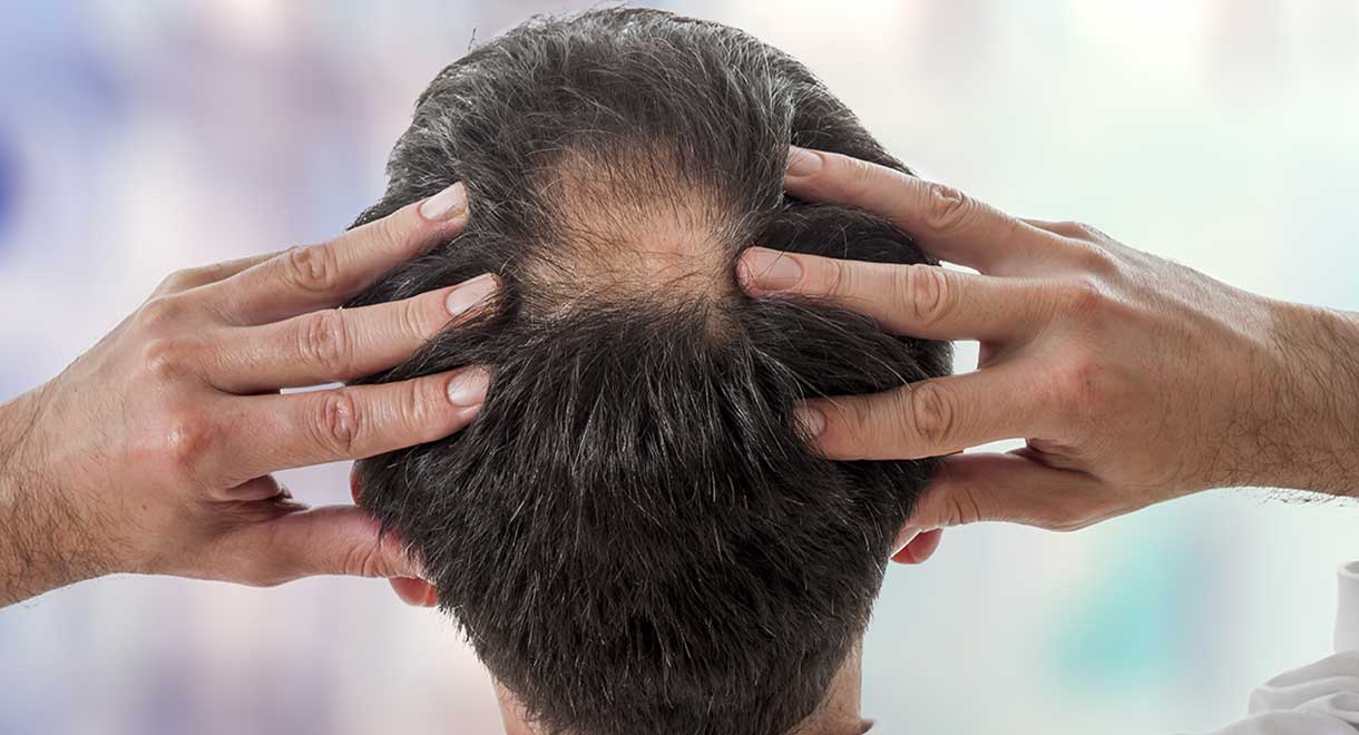 CBD OIL CAN BE BENEFICIAL TO HAIR LOSS